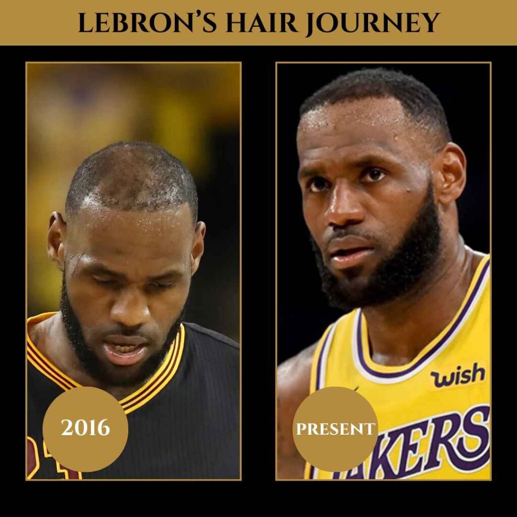 LeBron James Hairline Journey Side-by-side comparison of LeBron James’ hairline from 2016 and the present, showing his hair restoration progress.