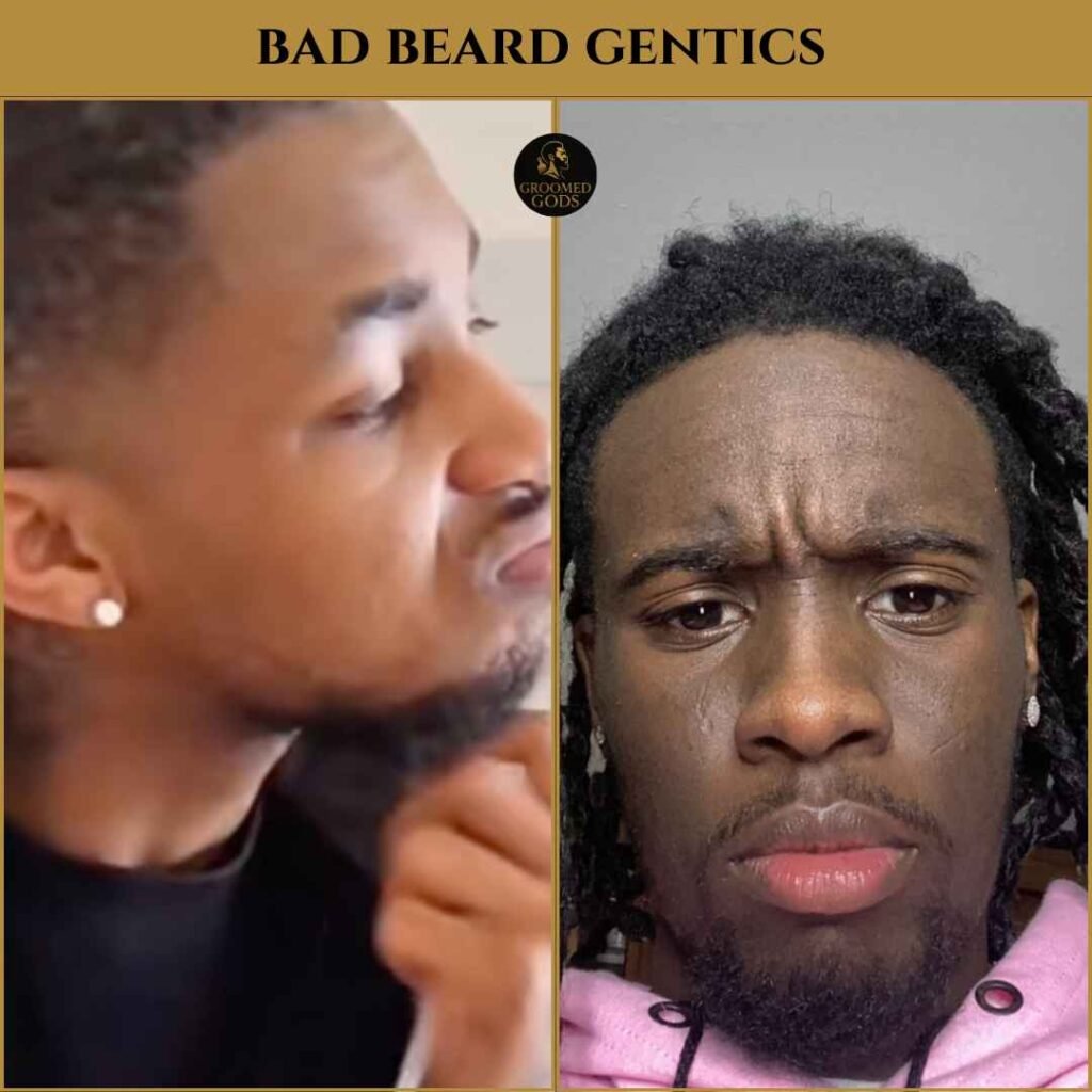 Bad Beard Genetics in Black Men – Patchy Beard Examples Bad beard genetics examples on Black men with patchy, uneven growth and weak mustache connection