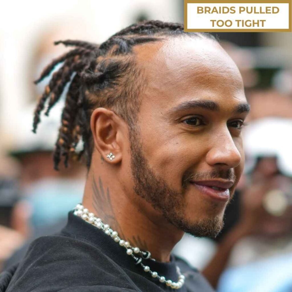 Braids Pulled Too Tight Hairstyle (Receding Hairline Risk) Black man with braids pulled too tight showing receding hairline risk
