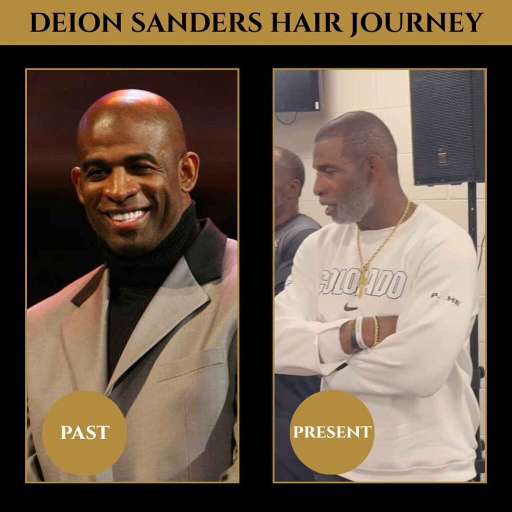 Deion Sanders Hair Transplant Journey (Past vs Present) Side-by-side comparison showing Deion Sanders before and after his hair transplant, highlighting the change from a receding hairline to a fuller, restored look labeled “Past” and “Present.”
