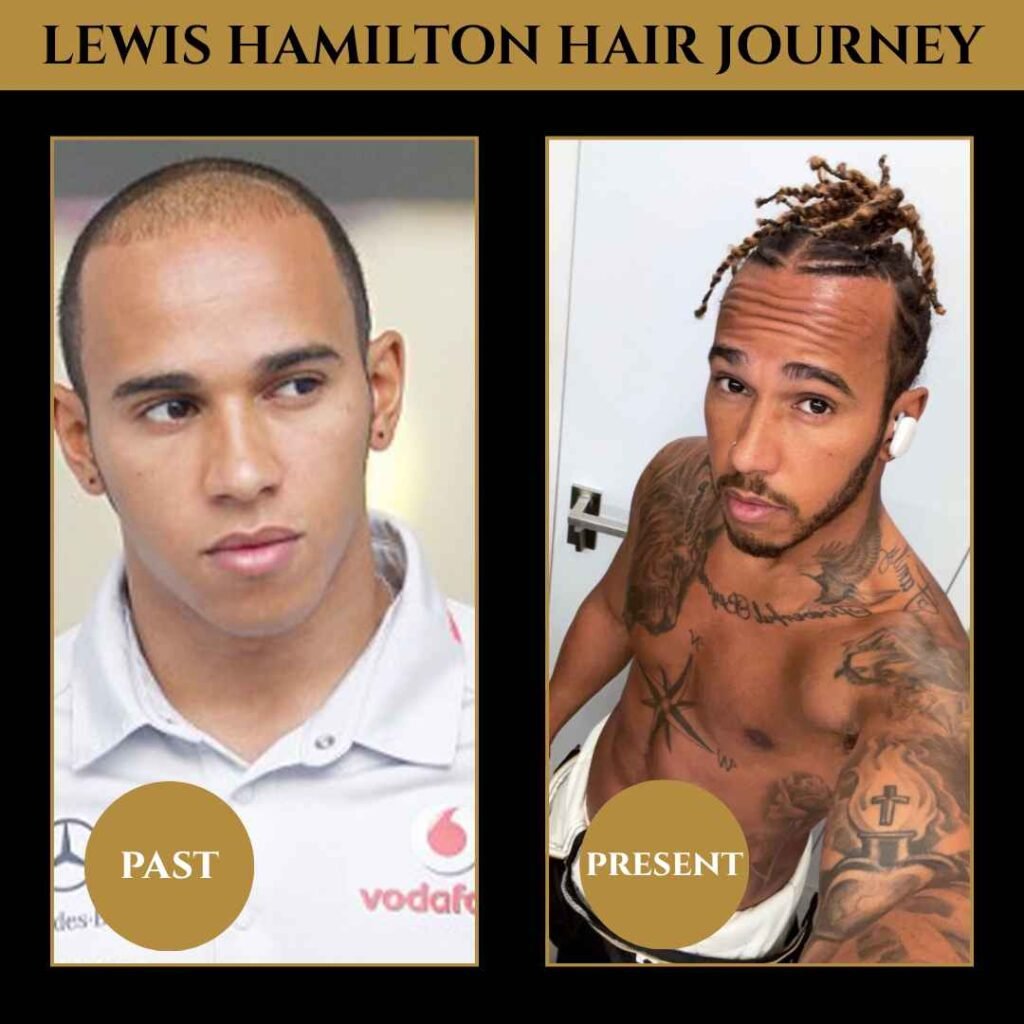 Lewis Hamilton Hair Transplant Journey (Past vs Present) Side-by-side image showing Lewis Hamilton’s hair transplant results, comparing his earlier shaved look to his current full braids, labeled “Past” and “Present.”
